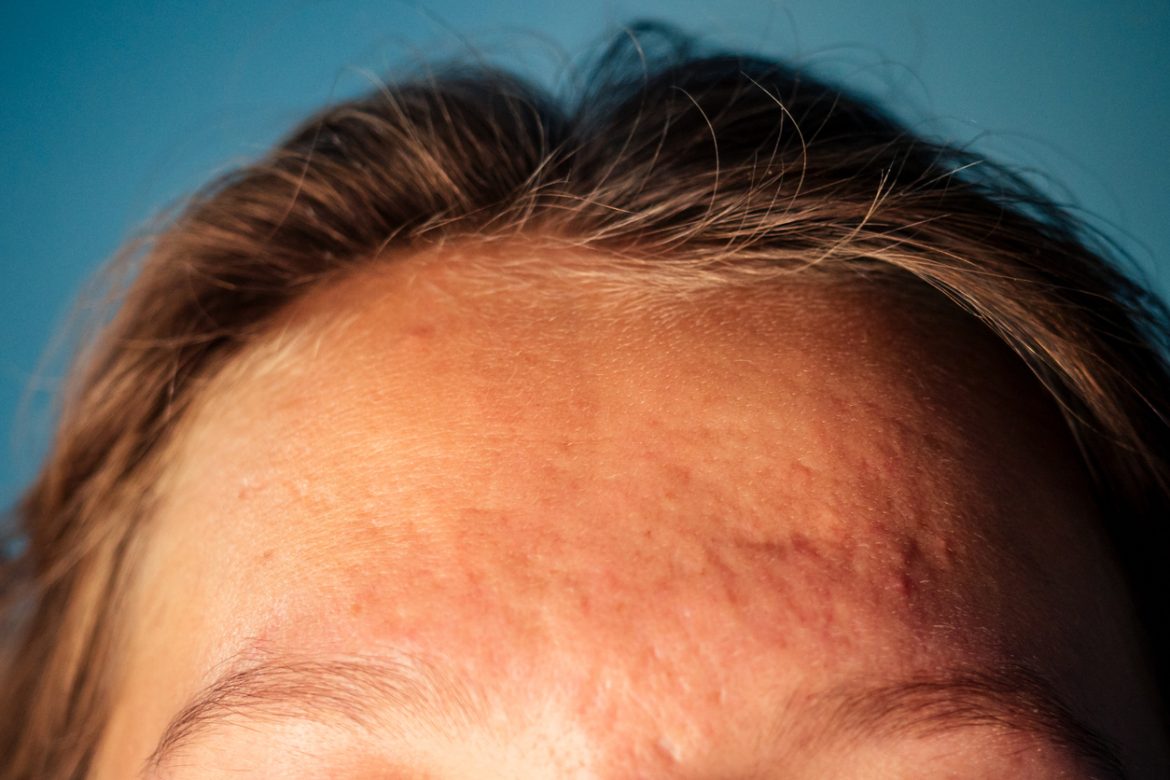 Cicatrices d’acné disgracieuses : comment les atténuer ?